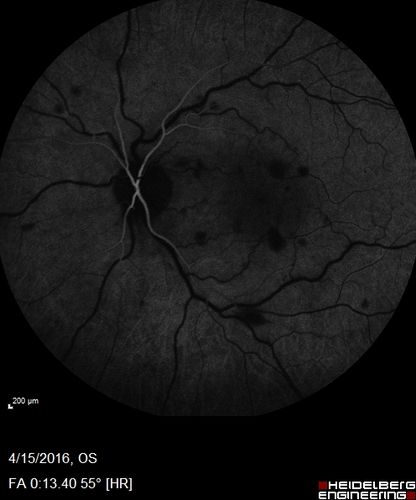 Central retinal artery and vein occlusion - Protein C Deficiency 33 year old male
33 year old male with vision loss for 3 hours.  VA 20/12 right eye, 5/200 left eye.  He has a protein C deficiency.  The left eye recovered vision in about 1 month to 20/16.  FA shows very slow recirculation time.
