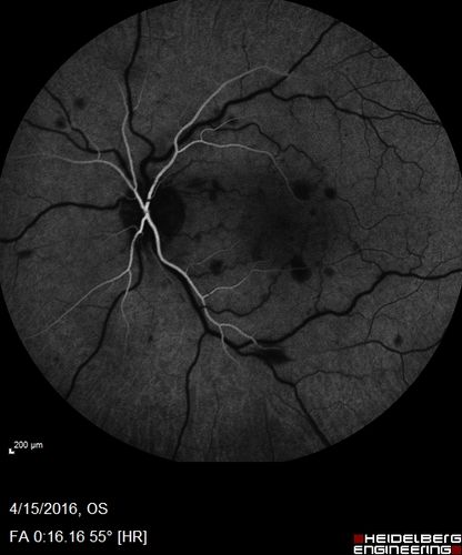 Central retinal artery and vein occlusion - Protein C Deficiency 33 year old male
33 year old male with vision loss for 3 hours.  VA 20/12 right eye, 5/200 left eye.  He has a protein C deficiency.  The left eye recovered vision in about 1 month to 20/16.  FA shows very slow recirculation time.
