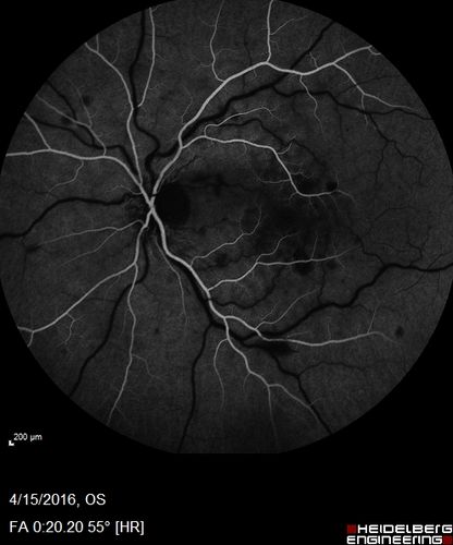 Central retinal artery and vein occlusion - Protein C Deficiency 33 year old male
33 year old male with vision loss for 3 hours.  VA 20/12 right eye, 5/200 left eye.  He has a protein C deficiency.  The left eye recovered vision in about 1 month to 20/16.  FA shows very slow recirculation time.
