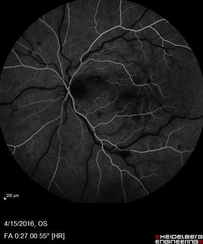 Central retinal artery and vein occlusion - Protein C Deficiency 33 year old male
33 year old male with vision loss for 3 hours.  VA 20/12 right eye, 5/200 left eye.  He has a protein C deficiency.  The left eye recovered vision in about 1 month to 20/16.  FA shows very slow recirculation time.
