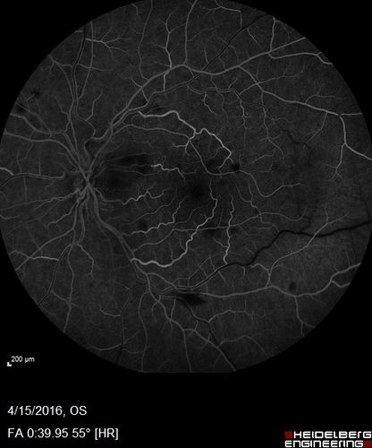 Central retinal artery and vein occlusion - Protein C Deficiency 33 year old male
33 year old male with vision loss for 3 hours.  VA 20/12 right eye, 5/200 left eye.  He has a protein C deficiency.  The left eye recovered vision in about 1 month to 20/16.  FA shows very slow recirculation time.
