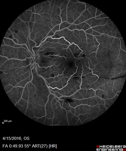 Central retinal artery and vein occlusion - Protein C Deficiency 33 year old male
33 year old male with vision loss for 3 hours.  VA 20/12 right eye, 5/200 left eye.  He has a protein C deficiency.  The left eye recovered vision in about 1 month to 20/16.  FA shows very slow recirculation time.
