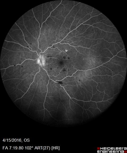 Central retinal artery and vein occlusion - Protein C Deficiency 33 year old male
33 year old male with vision loss for 3 hours.  VA 20/12 right eye, 5/200 left eye.  He has a protein C deficiency.  The left eye recovered vision in about 1 month to 20/16.  FA shows very slow recirculation time.
