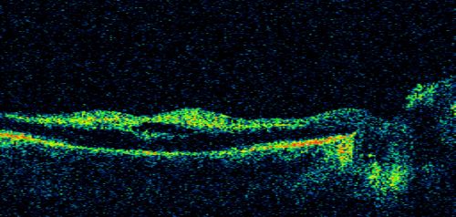 Central Retinal Artery Occlusion - 2 months old by history
77-year-old man was doing fine.  His left eye was a little worse than the right eye, and then in the 2 months ago he had sudden severe vision loss in the right eye.  Vision OD is 3/200; OS is 20/60.  IOP:  OD 30, OS 15.  
OD:  Vertical C/D ratio is 0.4.  The macula is white from ischemia.  The arteries are narrow.
Photos confirm clinical findings.
OCT SCAN:  OCT scan of the right eye shows retinal thickening, consistent with macular edema associated with a central retinal artery occlusion.  The left eye has severe inferior retinal thinning, consistent with an old hemicentral retinal artery occlusion in the left eye.  The fovea in the left eye is a little bit thin but not too bad.

IMPRESSION:  1.  CENTRAL RETINAL ARTERY OCCLUSION RIGHT EYE
2	OLD HEMICENTRAL RETINAL ARTERY OCCLUSION LEFT EYE
3	DIABETES WITHOUT RETINOPATHY
4	ELEVATED INTRAOCULAR PRESSURE RIGHT EYE STATUS POST INJECTION RIGHT EYE A WEEK AGO

DISCUSSION:  I explained to the patient that the right eye unfortunately has had a central retinal artery and unfortunately we do not have anything to treat that.  His vision will probably improve some over time.  He needs to be watched though.  It is possible he is developing rubeotic glaucoma, although it is probable the intraocular pressure is high from the injection last week.  I asked him to restart the Alphagan, to stop the other two drops, and to return here in three weeks to make sure his pressure is more acceptable.

At this point, having lost almost all the retinal circulation in the right eye and half of the retinal circulation in the left eye, he only has half a retina in the left eye he is working off of.  I told him it is very important he keep seeing you and anything that can be done to keep his blood pressure low and his cholesterol reasonable would be helpful to what remains of his retinal circulation.

Keywords: crao;central retinal artery occlusion