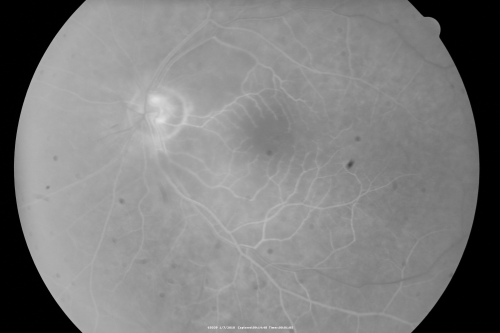Central Retinal Artery Occlusion Left Eye 2 Weeks Old - Still Non-Perfusion
85-year-old woman who had sudden severevision loss in the left eye two weeks ago.   she can see a little more centrally and much more in the periphery, since about the last four days. 

VISUAL ACUITY:  OD 20/30,  OS: Hand motion
Keywords: cherry red spot;retinal edema;crao