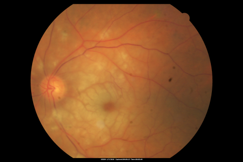 Central Retinal Artery Occlusion Left Eye 2 Weeks Old - Still Non-Perfusion
85-year-old woman who had sudden severevision loss in the left eye two weeks ago.   she can see a little more centrally and much more in the periphery, since about the last four days. 

VISUAL ACUITY:  OD 20/30,  OS: Hand motion
Keywords: cherry red spot;retinal edema;crao