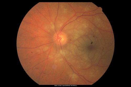 Central Retinal Artery Occlusion Left Eye 2 Weeks Old - Still Non-Perfusion
85-year-old woman who had sudden severevision loss in the left eye two weeks ago.   she can see a little more centrally and much more in the periphery, since about the last four days. 

VISUAL ACUITY:  OD 20/30,  OS: Hand motion
Keywords: cherry red spot;retinal edema;crao