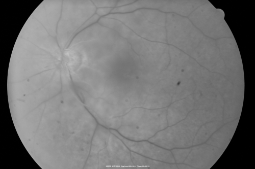 Central Retinal Artery Occlusion Left Eye 2 Weeks Old - Still Non-Perfusion
85-year-old woman who had sudden severevision loss in the left eye two weeks ago.   she can see a little more centrally and much more in the periphery, since about the last four days. 

VISUAL ACUITY:  OD 20/30,  OS: Hand motion
Schlüsselwörter: cherry red spot;retinal edema;crao