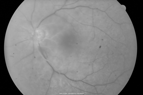 Central Retinal Artery Occlusion Left Eye 2 Weeks Old - Still Non-Perfusion
85-year-old woman who had sudden severevision loss in the left eye two weeks ago.   she can see a little more centrally and much more in the periphery, since about the last four days. 

VISUAL ACUITY:  OD 20/30,  OS: Hand motion
Keywords: cherry red spot;retinal edema;crao