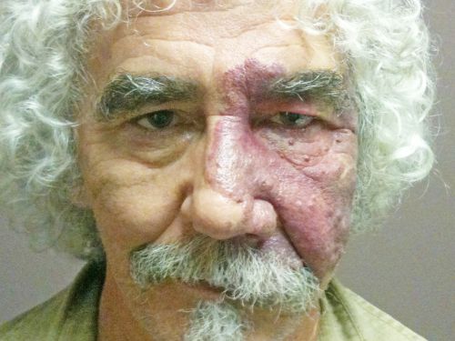 Sturge-Weber Encephalotigeminal Angiomatosis - Facial Hemangioma and Ipsilateral Diffuse Choroidal Hemangioma
61-year-old man with Sturge-Weber syndrome with a hemangioma on the left side of his face. 

VISUAL ACUITY:  Vision OD is 20/50, PH 20/30; OS 20/80, PH 20/30.  IOP:  OD 16, OS 19.

