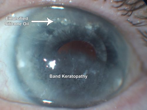 Silicone Oil in Anterior Chamber and Band Keratopathy 8 Years Post Complex Retinal Detachment Repair
81-year-old man had complex retinal detachment repairs in both eyes with silicone oil 8 years ago. The left eye has an oil fill.  He had a retinotomy very near to the macula and he has had silicone oil in the eye for a few years.  His eye is comfortable and the vision is stable.  OD is 20/200, OS is light perception
