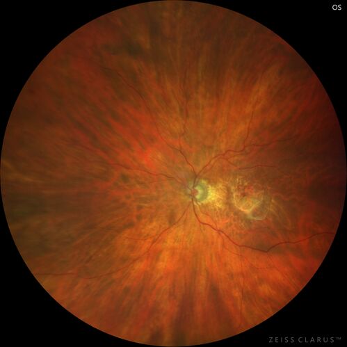CRVO with severe capillary non-perfusion
95 year old female 2-3 days of severe vision loss in the right eye.
The left eye lost vision to wet AMD after having a 8 month gap in therapy between 1/2020 (VA 20/50 OU) and 9/2020 (VA 20/25 OD, HM OS - COVID).  
PMHx: DM (on no medications), Thyroid
Meds: Artificial tears
VA HM OU
IOP: 18,19
Anterior segment: no rubeosis, pseudophakic
images look like vision loss was more than a few days in the right eye.
