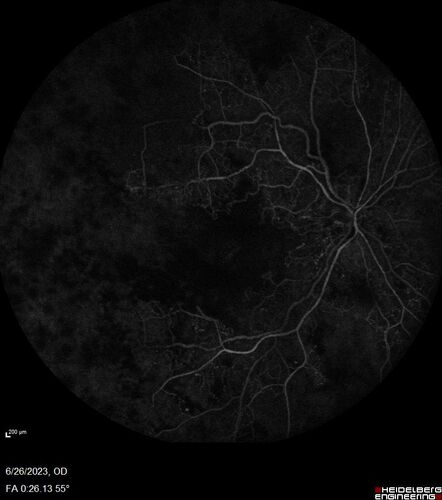 CRVO with severe capillary non-perfusion
95 year old female 2-3 days of severe vision loss in the right eye.
The left eye lost vision to wet AMD after having a 8 month gap in therapy between 1/2020 (VA 20/50 OU) and 9/2020 (VA 20/25 OD, HM OS - COVID).  
PMHx: DM (on no medications), Thyroid
Meds: Artificial tears
VA HM OU
IOP: 18,19
Anterior segment: no rubeosis, pseudophakic
images look like vision loss was more than a few days in the right eye.
