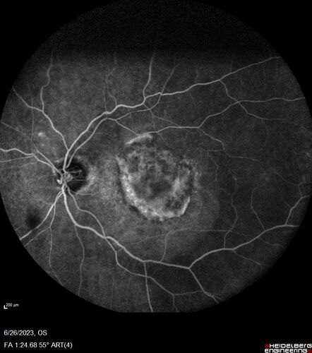 CRVO with severe capillary non-perfusion
95 year old female 2-3 days of severe vision loss in the right eye.
The left eye lost vision to wet AMD after having a 8 month gap in therapy between 1/2020 (VA 20/50 OU) and 9/2020 (VA 20/25 OD, HM OS - COVID).  
PMHx: DM (on no medications), Thyroid
Meds: Artificial tears
VA HM OU
IOP: 18,19
Anterior segment: no rubeosis, pseudophakic
images look like vision loss was more than a few days in the right eye.
