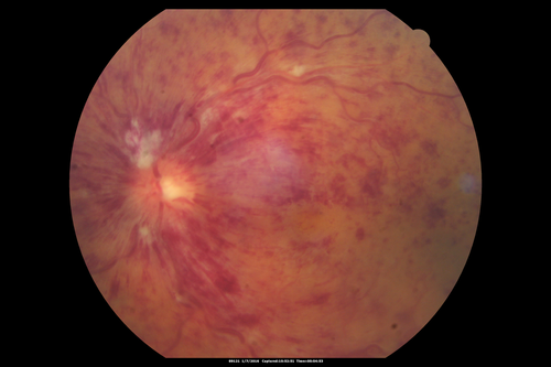Trousseau Sign - CRVO and Pancreatic Cancer
Left eye shows CRVO with severe edema.  The right eye has multiple small hemorrhages.  Some of this is probably anemic retinopathy and some from hypercoaguability of cancer.  The patient has pancreatic cancer.
