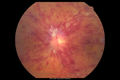 Trousseau Sign - CRVO and Pancreatic Cancer
Left eye shows CRVO with severe edema.  The right eye has multiple small hemorrhages.  Some of this is probably anemic retinopathy and some from hypercoaguability of cancer.  The patient has pancreatic cancer.
