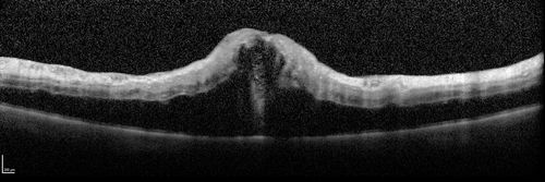 Trousseau Sign - CRVO and Pancreatic Cancer
Left eye shows CRVO with severe edema.  The right eye has multiple small hemorrhages.  Some of this is probably anemic retinopathy and some from hypercoaguability of cancer.  The patient has pancreatic cancer.
