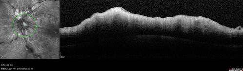 Trousseau Sign - CRVO and Pancreatic Cancer
Left eye shows CRVO with severe edema.  The right eye has multiple small hemorrhages.  Some of this is probably anemic retinopathy and some from hypercoaguability of cancer.  The patient has pancreatic cancer.
