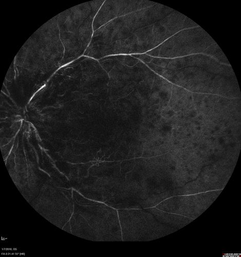 Trousseau Sign - CRVO and Pancreatic Cancer
Left eye shows CRVO with severe edema.  The right eye has multiple small hemorrhages.  Some of this is probably anemic retinopathy and some from hypercoaguability of cancer.  The patient has pancreatic cancer.
