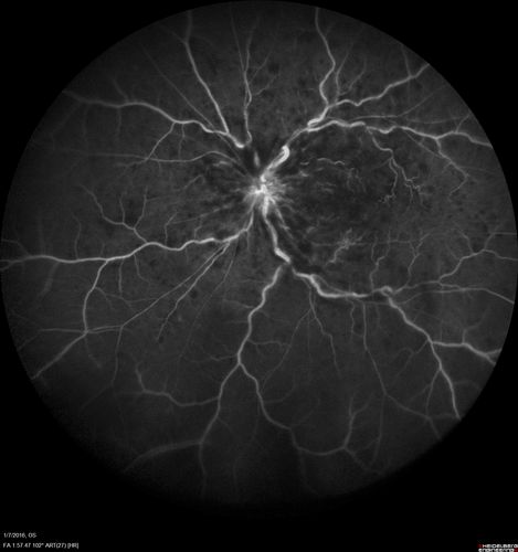Trousseau Sign - CRVO and Pancreatic Cancer
Left eye shows CRVO with severe edema.  The right eye has multiple small hemorrhages.  Some of this is probably anemic retinopathy and some from hypercoaguability of cancer.  The patient has pancreatic cancer.
