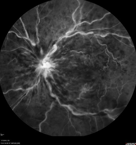 Trousseau Sign - CRVO and Pancreatic Cancer
Left eye shows CRVO with severe edema.  The right eye has multiple small hemorrhages.  Some of this is probably anemic retinopathy and some from hypercoaguability of cancer.  The patient has pancreatic cancer.
