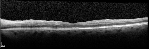 Trousseau Sign - CRVO and Pancreatic Cancer
Left eye shows CRVO with severe edema.  The right eye has multiple small hemorrhages.  Some of this is probably anemic retinopathy and some from hypercoaguability of cancer.  The patient has pancreatic cancer.
