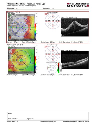 Trousseau Sign - CRVO and Pancreatic Cancer
Left eye shows CRVO with severe edema.  The right eye has multiple small hemorrhages.  Some of this is probably anemic retinopathy and some from hypercoaguability of cancer.  The patient has pancreatic cancer.
