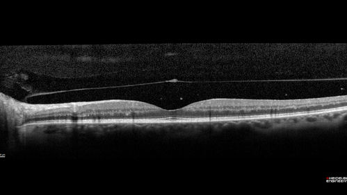 Central Retinal Vein Occlusion - No macular edema - Pre-foveal opercula
62 year old female with 20/20 vision.  She had been seeing a spot out of the left eye for 4 years and then noticed splotches in her vision.  She never devleoped edema or NV

