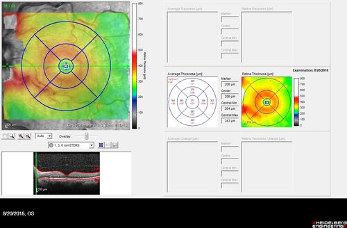 Central Retinal Vein Occlusion - No macular edema - Pre-foveal opercula
62 year old female with 20/20 vision.  She had been seeing a spot out of the left eye for 4 years and then noticed splotches in her vision.  She never devleoped edema or NV
