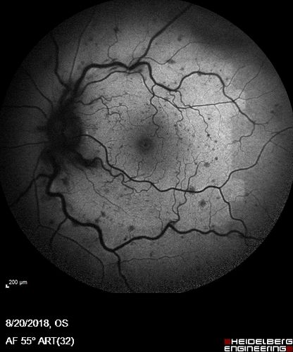 Central Retinal Vein Occlusion - No macular edema - Pre-foveal opercula
62 year old female with 20/20 vision.  She had been seeing a spot out of the left eye for 4 years and then noticed splotches in her vision.  She never devleoped edema or NV
