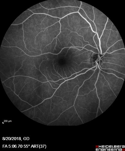 Central Retinal Vein Occlusion - No macular edema - Pre-foveal opercula
62 year old female with 20/20 vision.  She had been seeing a spot out of the left eye for 4 years and then noticed splotches in her vision.  She never devleoped edema or NV
