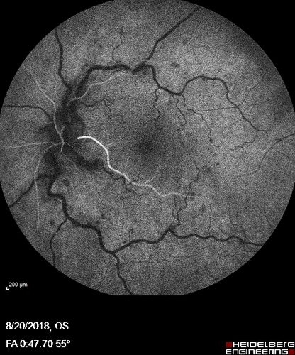 Central Retinal Vein Occlusion - No macular edema - Pre-foveal opercula
62 year old female with 20/20 vision.  She had been seeing a spot out of the left eye for 4 years and then noticed splotches in her vision.  She never devleoped edema or NV

