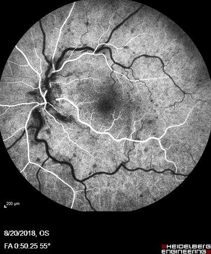Central Retinal Vein Occlusion - No macular edema - Pre-foveal opercula
62 year old female with 20/20 vision.  She had been seeing a spot out of the left eye for 4 years and then noticed splotches in her vision.  She never devleoped edema or NV

