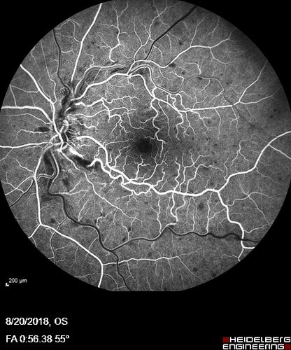 Central Retinal Vein Occlusion - No macular edema - Pre-foveal opercula
62 year old female with 20/20 vision.  She had been seeing a spot out of the left eye for 4 years and then noticed splotches in her vision.  She never devleoped edema or NV
