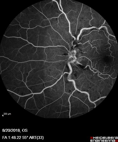 Central Retinal Vein Occlusion - No macular edema - Pre-foveal opercula
62 year old female with 20/20 vision.  She had been seeing a spot out of the left eye for 4 years and then noticed splotches in her vision.  She never devleoped edema or NV
