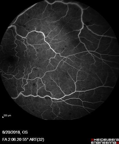 Central Retinal Vein Occlusion - No macular edema - Pre-foveal opercula
62 year old female with 20/20 vision.  She had been seeing a spot out of the left eye for 4 years and then noticed splotches in her vision.  She never devleoped edema or NV

