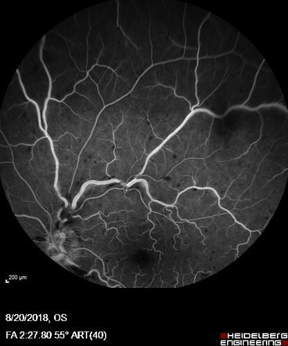 Central Retinal Vein Occlusion - No macular edema - Pre-foveal opercula
62 year old female with 20/20 vision.  She had been seeing a spot out of the left eye for 4 years and then noticed splotches in her vision.  She never devleoped edema or NV
