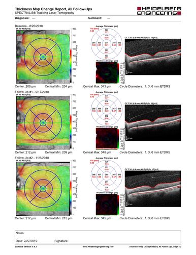 Central Retinal Vein Occlusion - No macular edema - Pre-foveal opercula
62 year old female with 20/20 vision.  She had been seeing a spot out of the left eye for 4 years and then noticed splotches in her vision.  She never devleoped edema or NV

