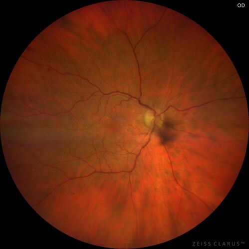 Central Retinal Vein Occlusion following Cataract Surgery
79 year old man with decreased vision The patient had cataract surgery in the right eye 9 days ago and in the left eye 21 days ago and presents with vision loss in the right eye. 

Meds: HCTZ, Garlic, Tumeric
VA 20/60 OD, 20/25 OS
