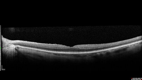 Central Retinal Vein Occlusion following Cataract Surgery
79 year old man with decreased vision The patient had cataract surgery in the right eye 9 days ago and in the left eye 21 days ago and presents with vision loss in the right eye. 

Meds: HCTZ, Garlic, Tumeric
VA 20/60 OD, 20/25 OS
