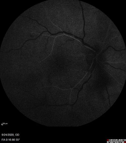 Central Retinal Vein Occlusion following Cataract Surgery
79 year old man with decreased vision The patient had cataract surgery in the right eye 9 days ago and in the left eye 21 days ago and presents with vision loss in the right eye. 

Meds: HCTZ, Garlic, Tumeric
VA 20/60 OD, 20/25 OS

