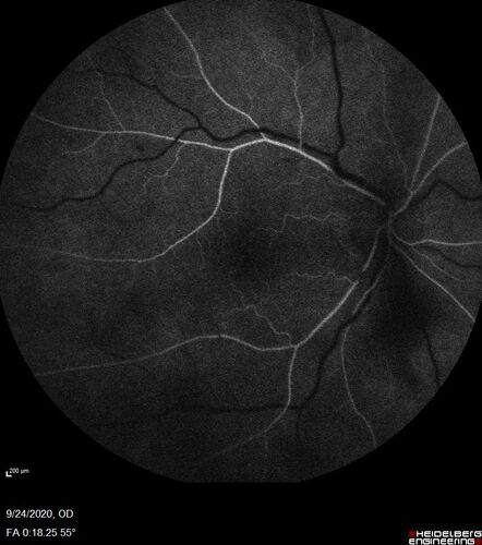 Central Retinal Vein Occlusion following Cataract Surgery
79 year old man with decreased vision The patient had cataract surgery in the right eye 9 days ago and in the left eye 21 days ago and presents with vision loss in the right eye. 

Meds: HCTZ, Garlic, Tumeric
VA 20/60 OD, 20/25 OS
