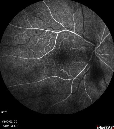Central Retinal Vein Occlusion following Cataract Surgery
79 year old man with decreased vision The patient had cataract surgery in the right eye 9 days ago and in the left eye 21 days ago and presents with vision loss in the right eye. 

Meds: HCTZ, Garlic, Tumeric
VA 20/60 OD, 20/25 OS
