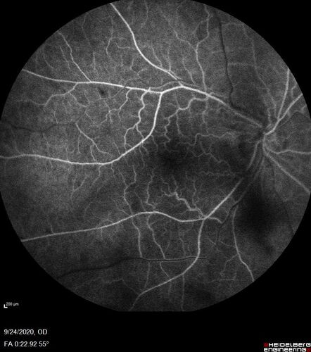 Central Retinal Vein Occlusion following Cataract Surgery
79 year old man with decreased vision The patient had cataract surgery in the right eye 9 days ago and in the left eye 21 days ago and presents with vision loss in the right eye. 

Meds: HCTZ, Garlic, Tumeric
VA 20/60 OD, 20/25 OS
