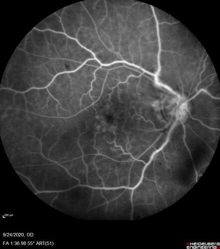Central Retinal Vein Occlusion following Cataract Surgery
79 year old man with decreased vision The patient had cataract surgery in the right eye 9 days ago and in the left eye 21 days ago and presents with vision loss in the right eye. 

Meds: HCTZ, Garlic, Tumeric
VA 20/60 OD, 20/25 OS
