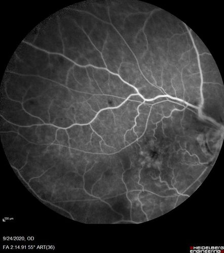 Central Retinal Vein Occlusion following Cataract Surgery
79 year old man with decreased vision The patient had cataract surgery in the right eye 9 days ago and in the left eye 21 days ago and presents with vision loss in the right eye. 

Meds: HCTZ, Garlic, Tumeric
VA 20/60 OD, 20/25 OS
