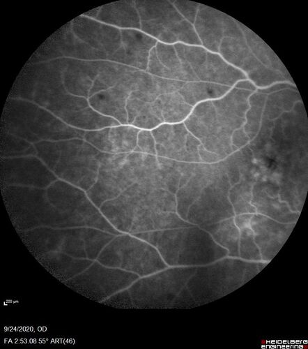 Central Retinal Vein Occlusion following Cataract Surgery
79 year old man with decreased vision The patient had cataract surgery in the right eye 9 days ago and in the left eye 21 days ago and presents with vision loss in the right eye. 

Meds: HCTZ, Garlic, Tumeric
VA 20/60 OD, 20/25 OS
