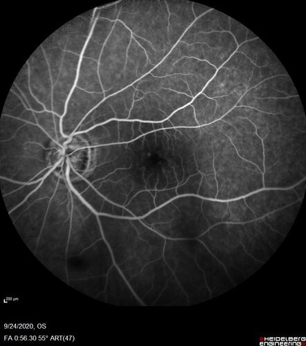 Central Retinal Vein Occlusion following Cataract Surgery
79 year old man with decreased vision The patient had cataract surgery in the right eye 9 days ago and in the left eye 21 days ago and presents with vision loss in the right eye. 

Meds: HCTZ, Garlic, Tumeric
VA 20/60 OD, 20/25 OS
