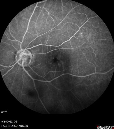 Central Retinal Vein Occlusion following Cataract Surgery
79 year old man with decreased vision The patient had cataract surgery in the right eye 9 days ago and in the left eye 21 days ago and presents with vision loss in the right eye. 

Meds: HCTZ, Garlic, Tumeric
VA 20/60 OD, 20/25 OS
