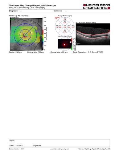 Central Retinal Vein Occlusion following Cataract Surgery
79 year old man with decreased vision The patient had cataract surgery in the right eye 9 days ago and in the left eye 21 days ago and presents with vision loss in the right eye. 

Meds: HCTZ, Garlic, Tumeric
VA 20/60 OD, 20/25 OS
